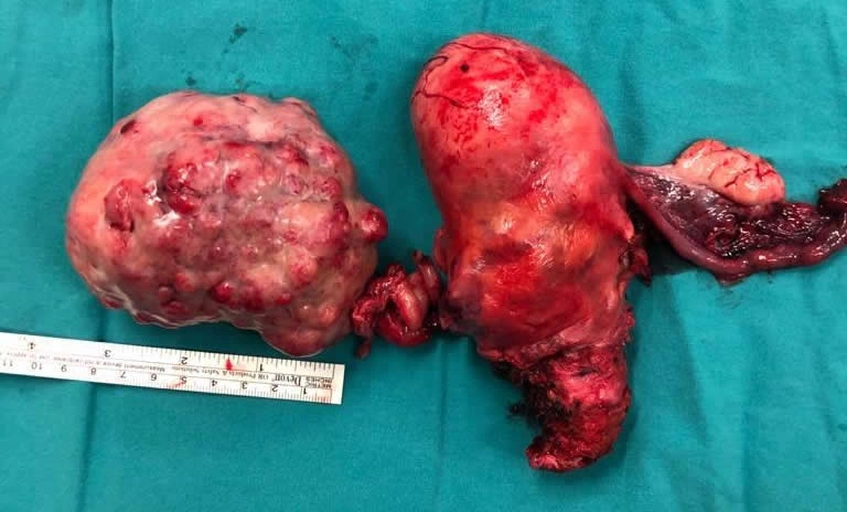 Yumurtalık kanseri ameliyatı İstanbul